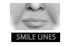 SMILE LINES